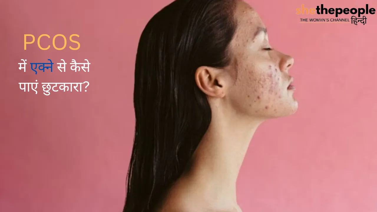 Acne During PCOS