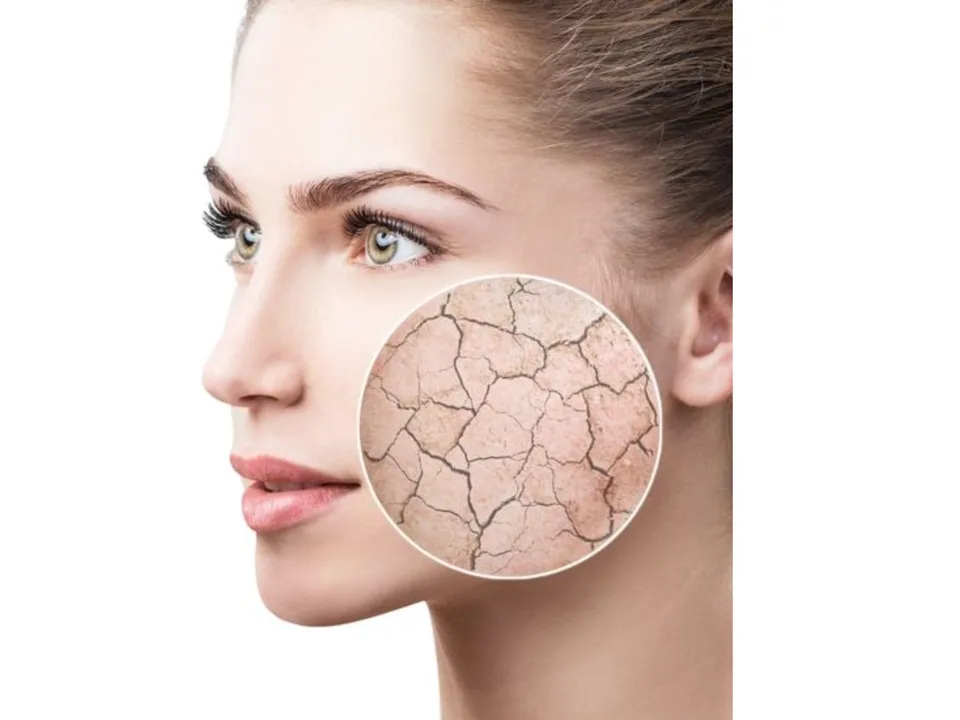 Avoid Dry Skin 