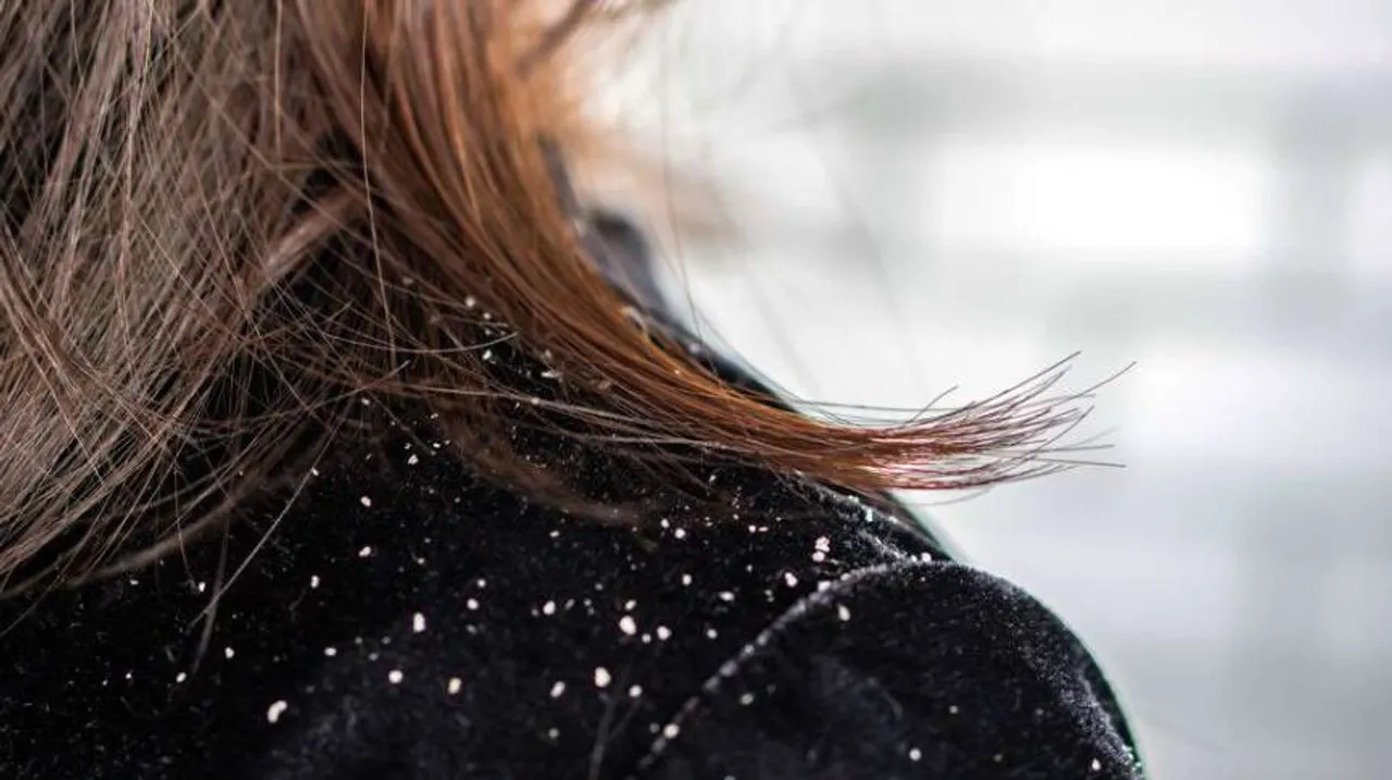 dandruff tips 