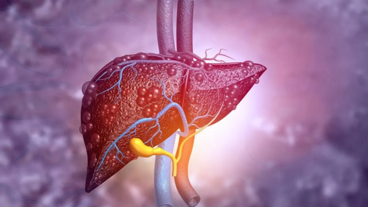 Fatty liver??