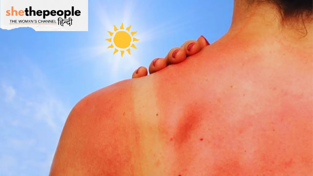 sun burn.png