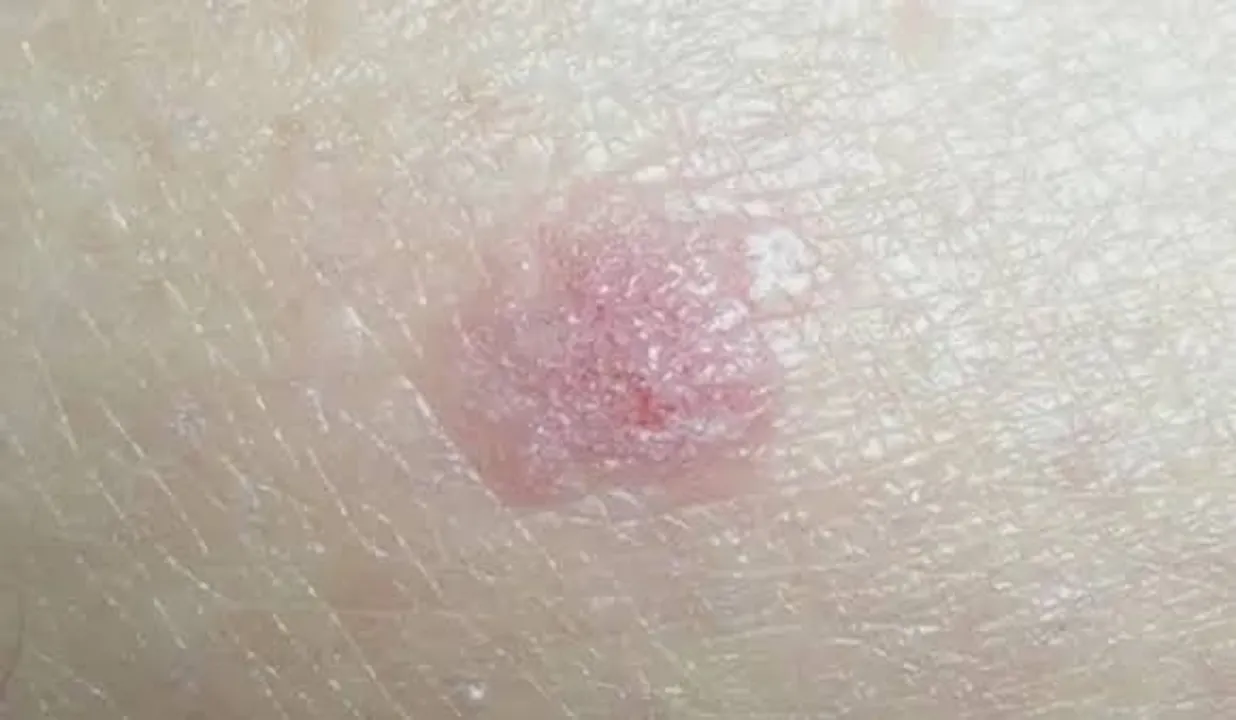 Itching 