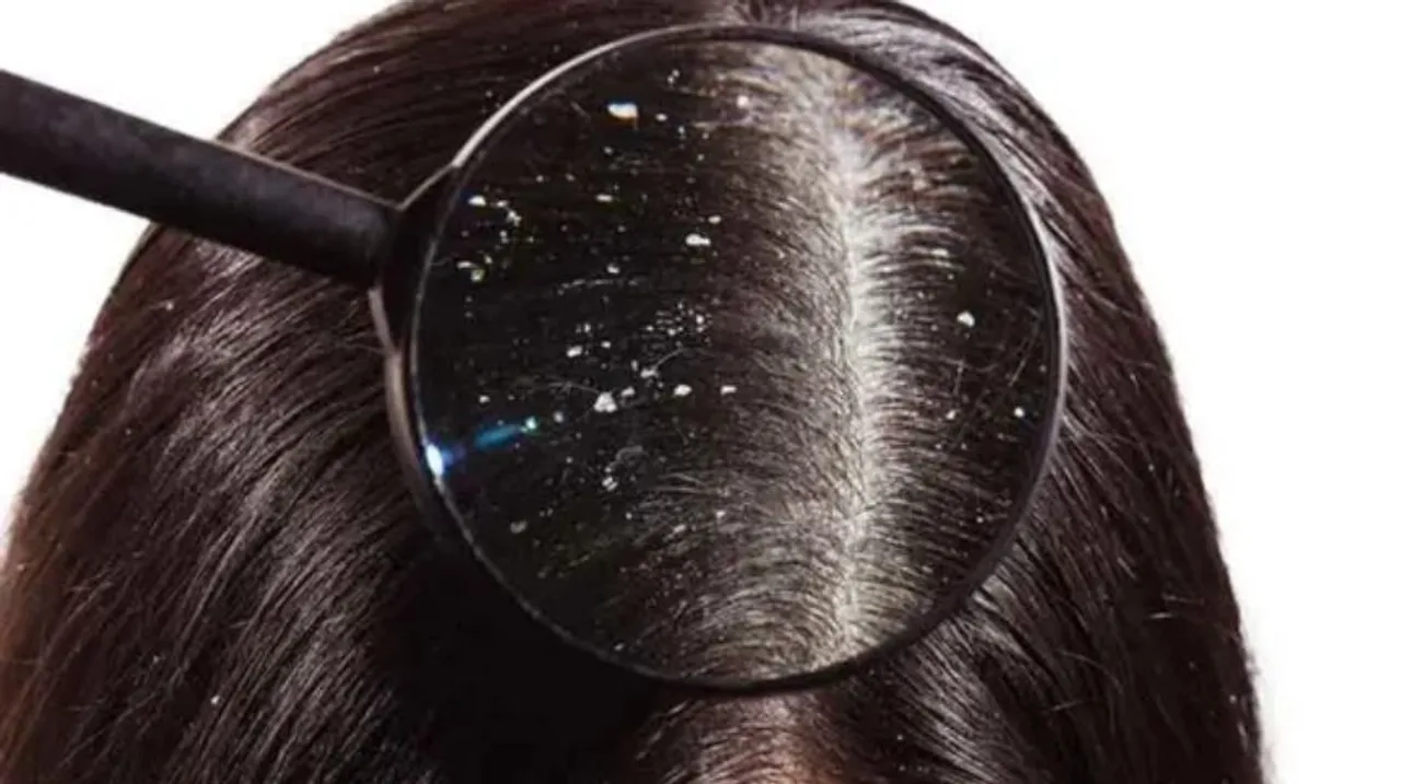 dandruff 
