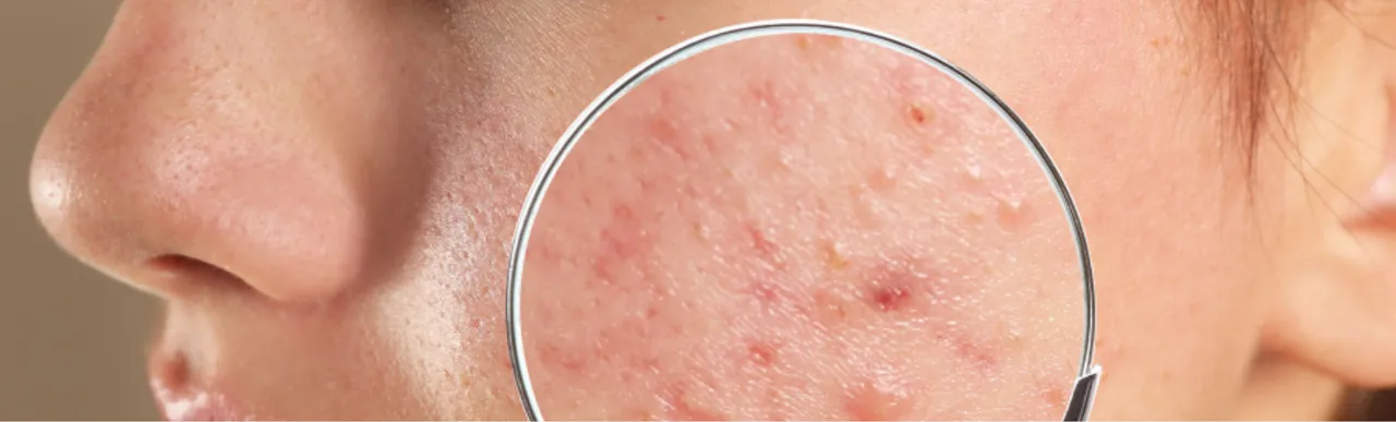 Acne 0000. png
