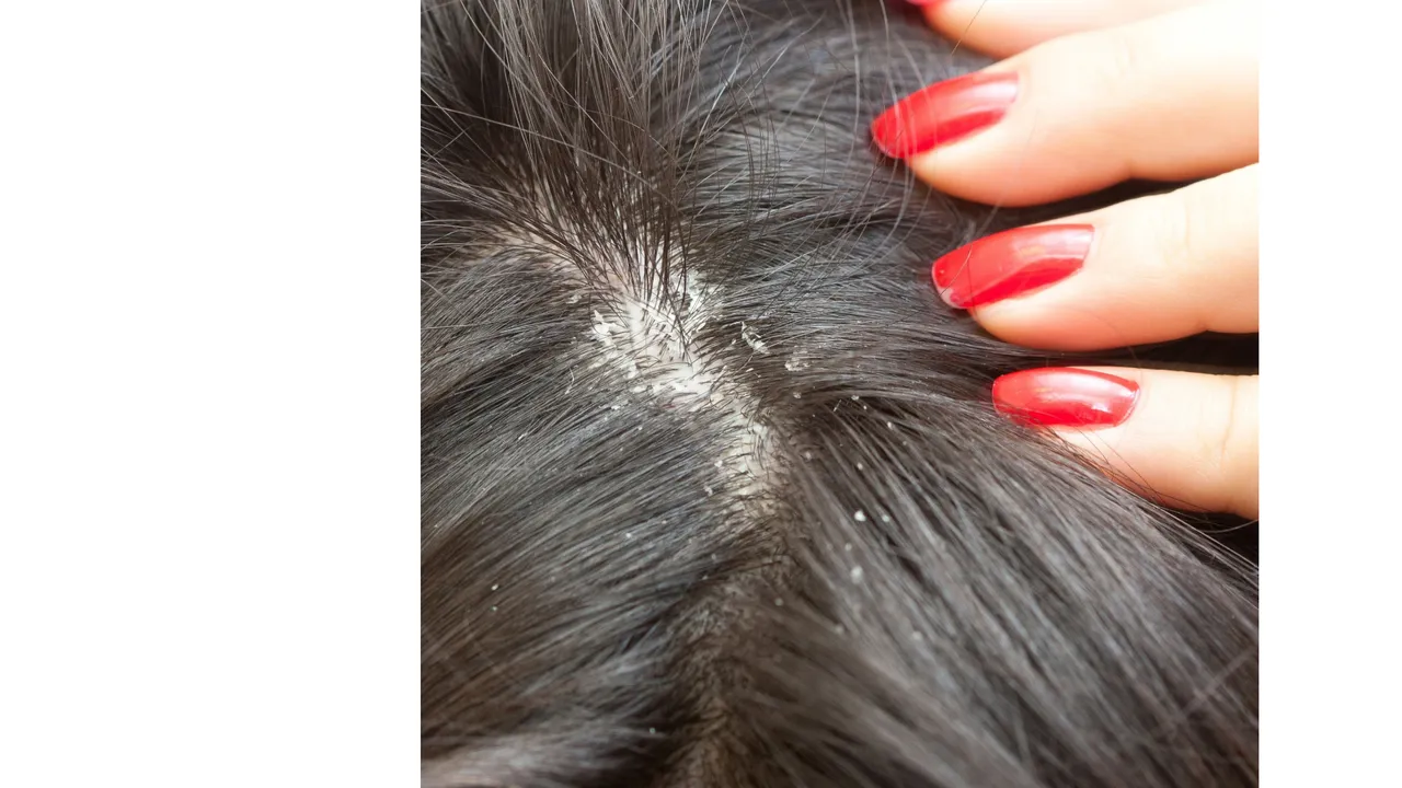 Dandruff (Prevention).png