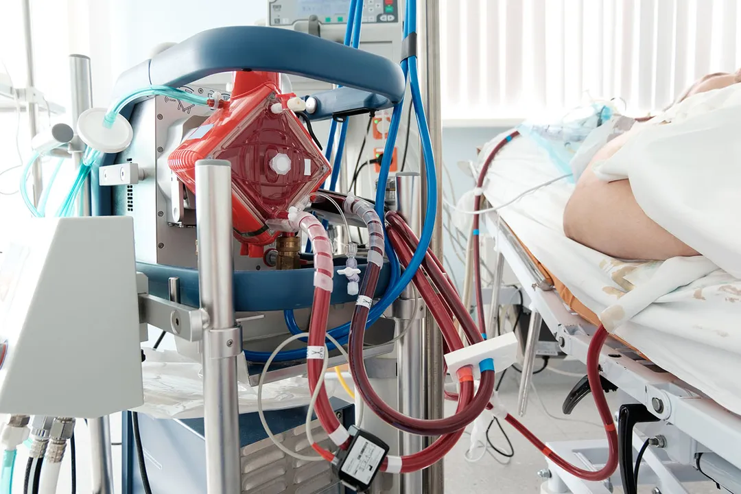 ECMO प्रक्रिया Covid-19 रोगियों के लिए कैसे काम करती है?