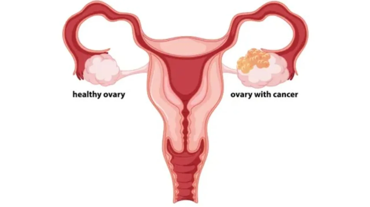 Ovarian Cancer के बारे में यह बातें ज़रूरी है आपके लिए जानना