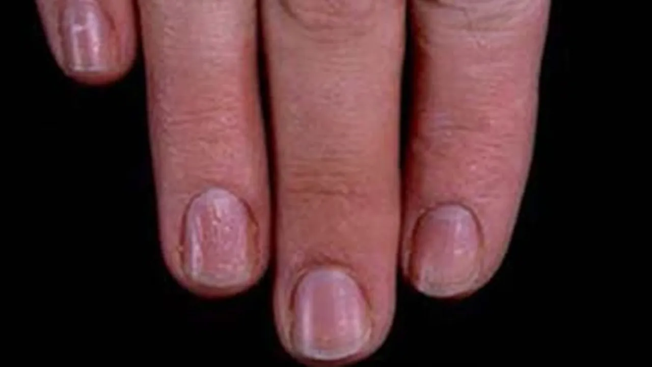 Nail Health Signs: নখের রোগের লক্ষণগুলো জেনে নিন।