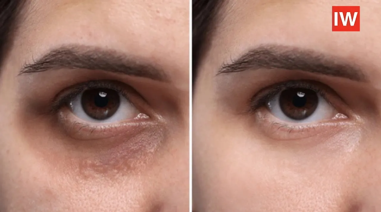  Under Eye Dark Circles No More: CO₂ Injections Enter Beauty Scene