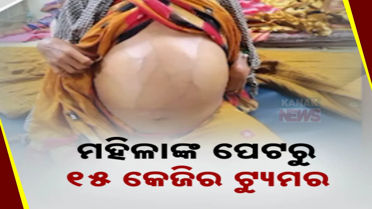  ମହିଳାଙ୍କ ପେଟରୁ ବାହାରିଲା ୧୫ କେଜିର ଟ୍ୟୁମର ! ଅସ୍ତ୍ରୋପଚାର ପରେ ମହିଳା ପାଇଲେ ନୂଆ ଜୀବନ