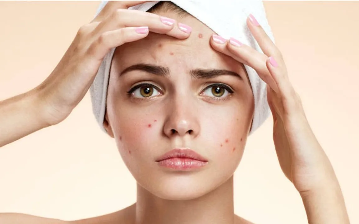  Acne  Photograph: (google) 