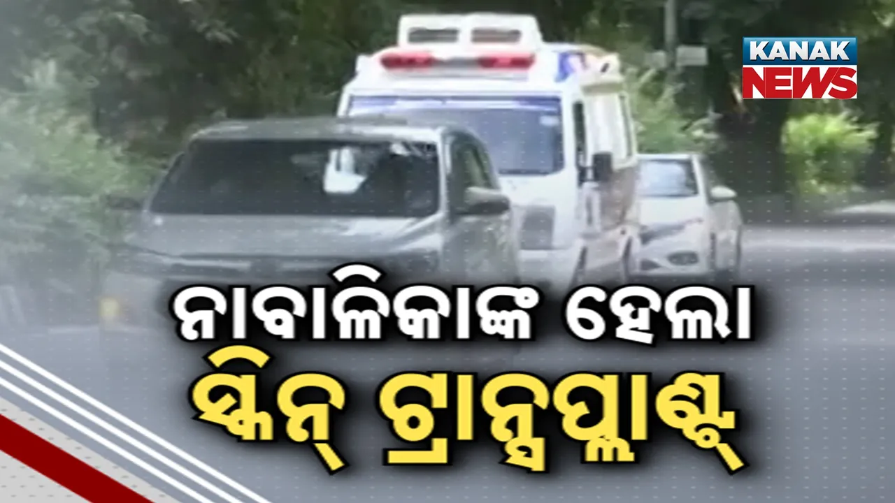  ନାବାଳିକାଙ୍କ ହେଲା ସ୍କିନ୍‌ ଟ୍ରାନ୍ସପ୍ଲାଣ୍ଟ୍‌ Photograph: (KanakNews) 