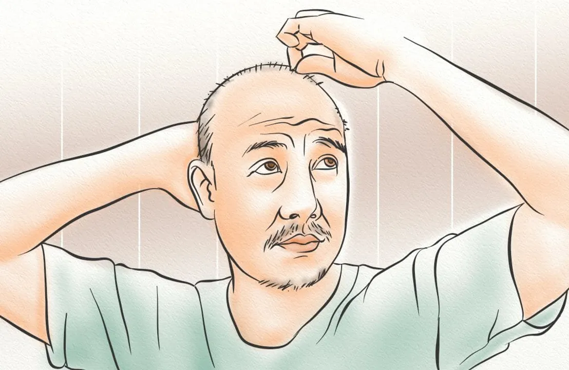  Source:Hair Loss Revolution 
