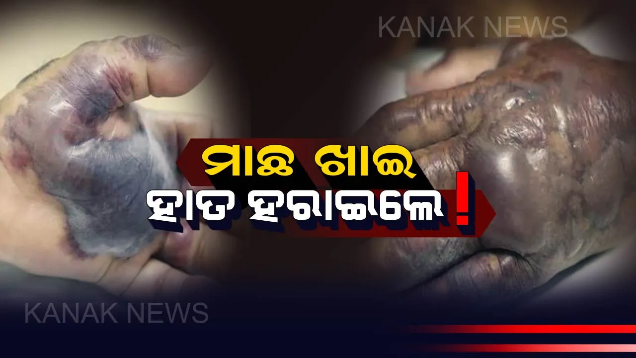  ସାବଧାନ୍ ! ମାଛ ଖାଇବା ପରେ ପଚିଗଲା ଚର୍ମ, ଶେଷରେ ଡାକ୍ତରଙ୍କୁ କାଟିବାକୁ ପଡିଲା ଯୁବକଙ୍କ ହାତ