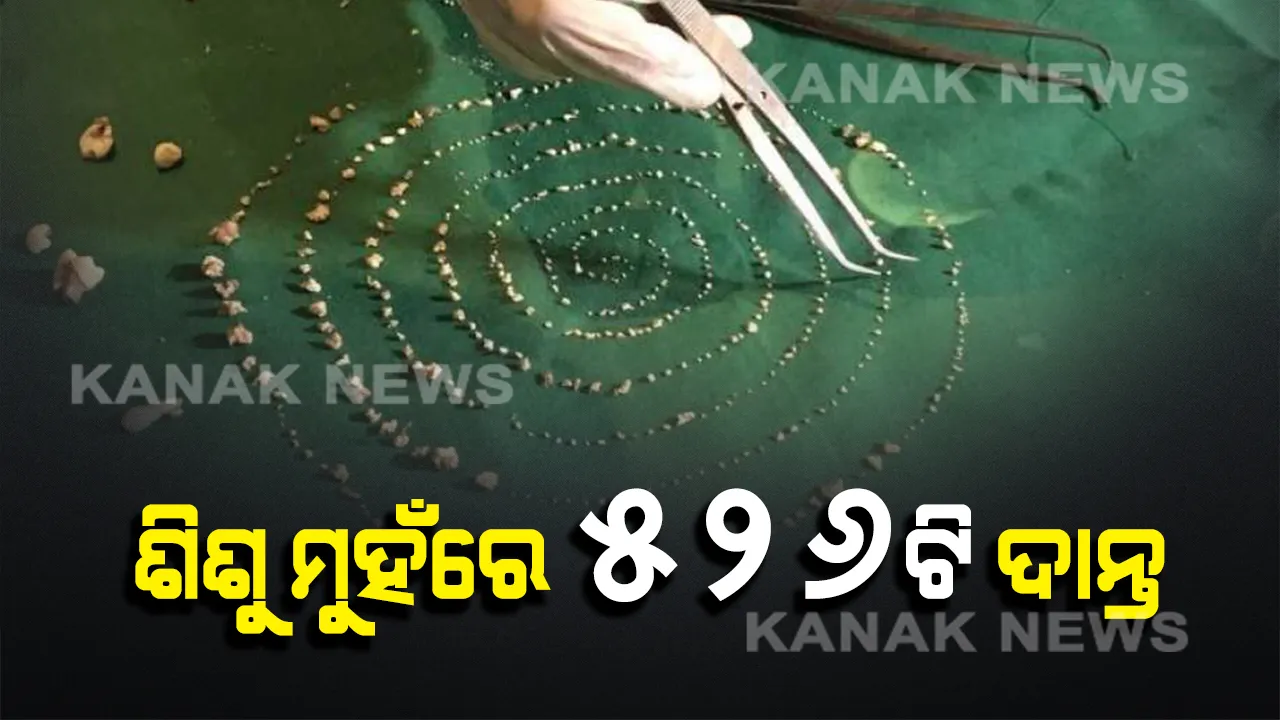  ୭ ବର୍ଷର ଶିଶୁ ମୁହଁରେ ୫୨୬ଟି ଦାନ୍ତ ! ଡାକ୍ତର ମଧ୍ୟ ହୋଇଗଲେ ଆଶ୍ଚର୍ଯ୍ୟ, ଦୀର୍ଘ ୫ ଘଂଟାର ବିରଳ ଅସ୍ତ୍ରୋପଚାର ପରେ ବାହାରିଲା ଅତିରିକ୍ତ ଦାନ୍ତ ।