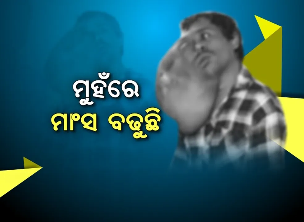  ମୁହଁରେ ବଢୁଛି ମାଂସ ପିଣ୍ଡୁଳା। ଜୀବନକୁ ବଳି ପଡୁଛି ଯନ୍ତ୍ରଣା। ଚିକିତ୍ସା ପାଇଁ ସରକାରୀ ସହାୟତା ନମିଳିଲେ ଇଚ୍ଛାମୃତ୍ୟୁ ପାଇଁ ଅନୁମତି ଦେବାକୁ ମନବୋଧଙ୍କ ନିବେଦନ