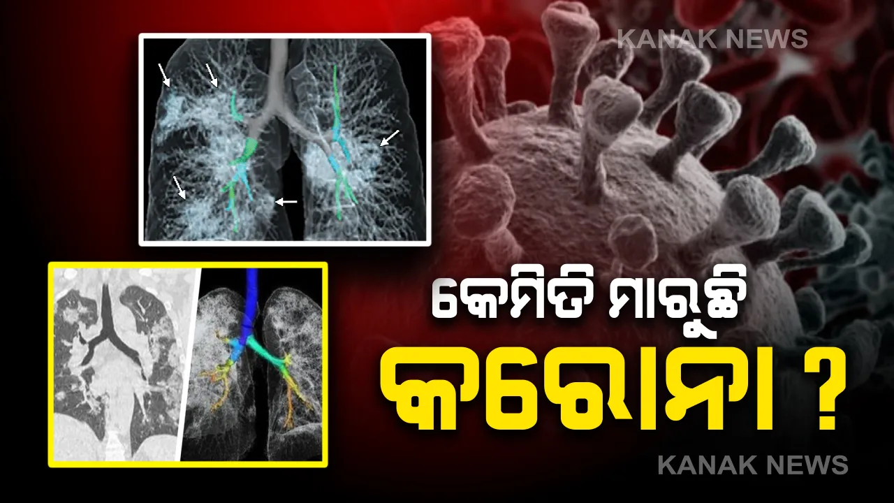  କେମିତି ମାରୁଛି କରୋନା ? ସବୁ ରୋଗୀଙ୍କ ପାଖରେ ଦେଖିବାକୁ ମିଳୁଛି ସମାନ ଅସୁବିଧା । ଫୁସଫୁସରେ ପବନ ବଦଳରେ ପଶୁଛି କରୋନା ଭୁତାଣୁ , ଏକ୍ସ-ରେରେ ଦେଖାଗଲା ଧଳା ଜମାଟ । 
