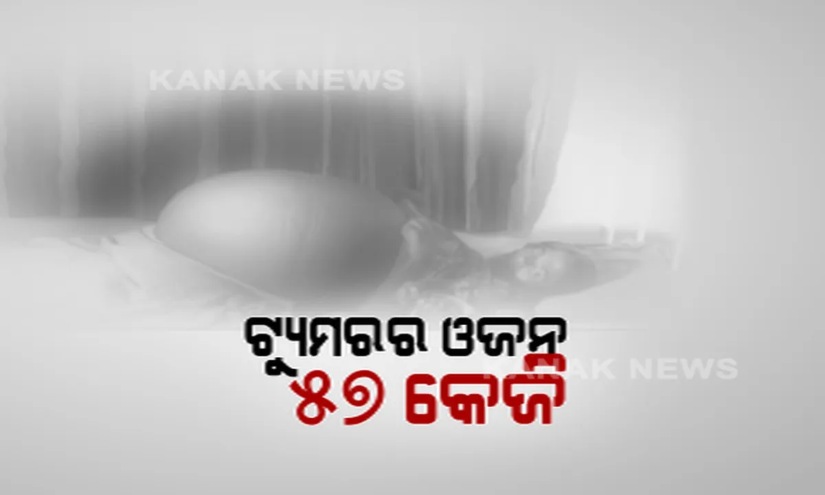  ସଫଳ ହେଲା ବିରଳ ଅସ୍ତ୍ରୋପଚାର । ମହିଳାଙ୍କ ପେଟରୁ ବାହାରିଲା ୫୭ କେଜିର ଟ୍ୟୁମର । ୧୦ ବର୍ଷ ଧରି ଯନ୍ତ୍ରଣାରେ ଛଟପଟ ହେଉଥିଲେ କୋରାପୁଟର ମହିଳା । ଖୋର୍ଦ୍ଧା କୁହୁଡି ସାଇ ସେବା ସଦନର ଚିକିତ୍ସକଙ୍କ ଉଦ୍ୟମକୁ ପ୍ରଶଂସା