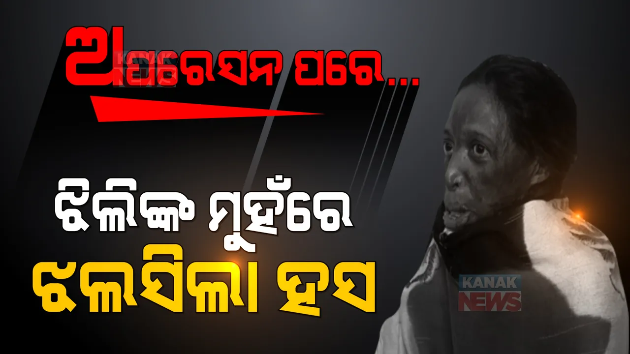  ଝିଲିଙ୍କ ମୁହଁରେ ଝଲସୁଛି ହସ... ଅପରେସନ ଆଣିଦେଲା ନୂଆ ଆଶା, ଦେଖାଇଲା ବଞ୍ଚିବାର ବାଟ । ନିଆଁରେ ପୋଡିଯାଇଥିଲା ପୂରା ଶରୀର