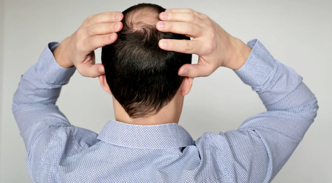  Baldness, man in office shirt concerned about hair loss. Male head with a bald, concept of stress at work 