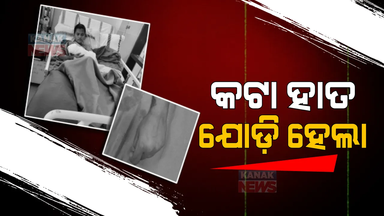  ଭୁବନେଶ୍ୱର ଏମ୍ସରେ ବିରଳ ଅସ୍ତ୍ରୋପ୍ରଚାର। ହାତ କଟିଯିବାର ୮ଘଣ୍ଟା ପରେ ଆସିଥିଲେ ବି ଯୋଡିବାରେ ସଫଳ ହେଲେ ଡାକ୍ତର।