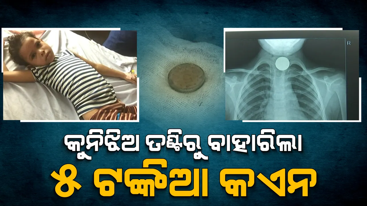  ବାଲେଶ୍ୱରର କୁନି ଝିଅ ଛାୟା ତଣ୍ଟିରୁ ବାହାରିଲା ୫ ଟଙ୍କିଆ କଏନ । କଟକ ବଡ ମେଡିକାଲରେ ବାହାର କଲେ ଡାକ୍ତର ।