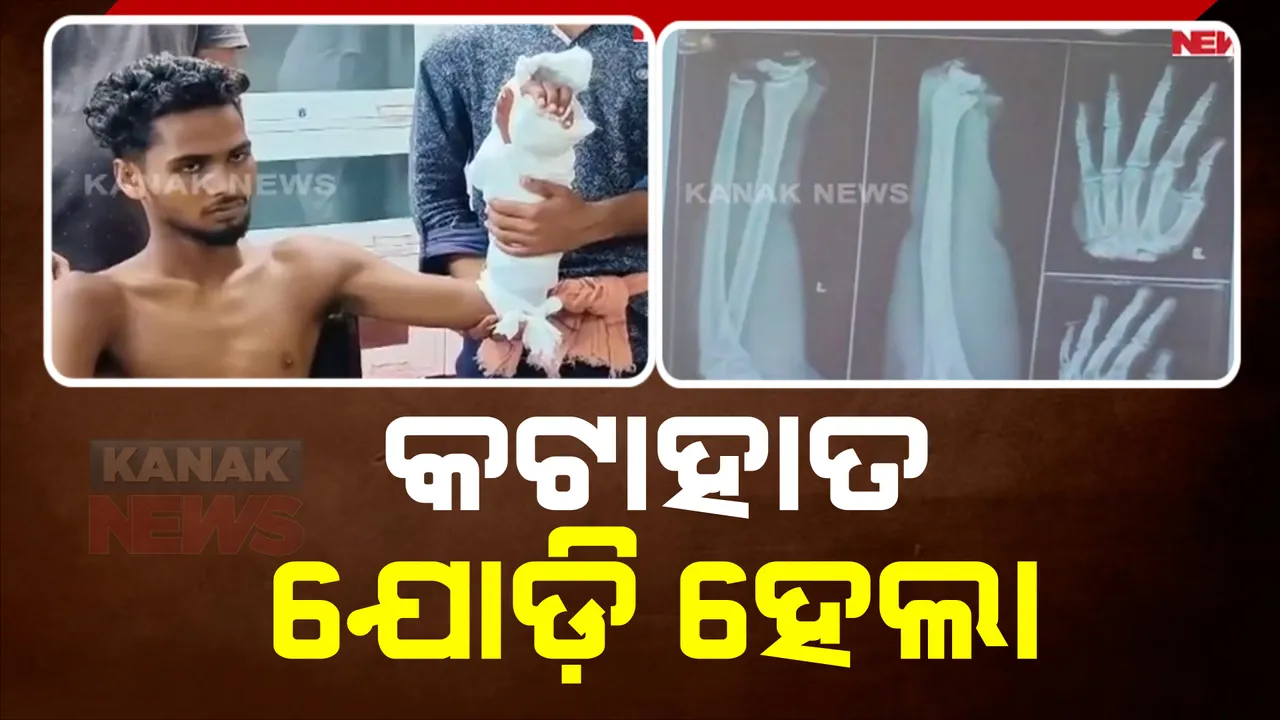  କଟକ ବଡ ମେଡିକାଲରେ ବିରଳ ଅସ୍ତ୍ରୋପଚାର। ୬ ଘଣ୍ଟାର ଅପରେସନରେ ଯୋଡିହେଲା କଟା ହାତ