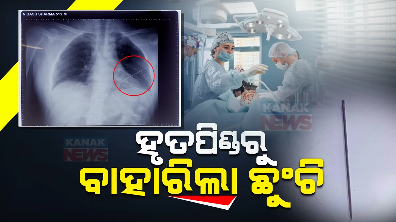  ହୃତପିଣ୍ଡରୁ ବାହାରିଲା ୪ ଇଞ୍ଚର ଛୁଞ୍ଚି । ଏସସିବିରେ ଜଟିଳ ଅସ୍ତ୍ରୋପଚାର ସଫଳ । ନୂଆ ଜୀବନ ପାଇଲେ ଭୁବନେଶ୍ୱର ନିବାସୀ ଶର୍ମା ।