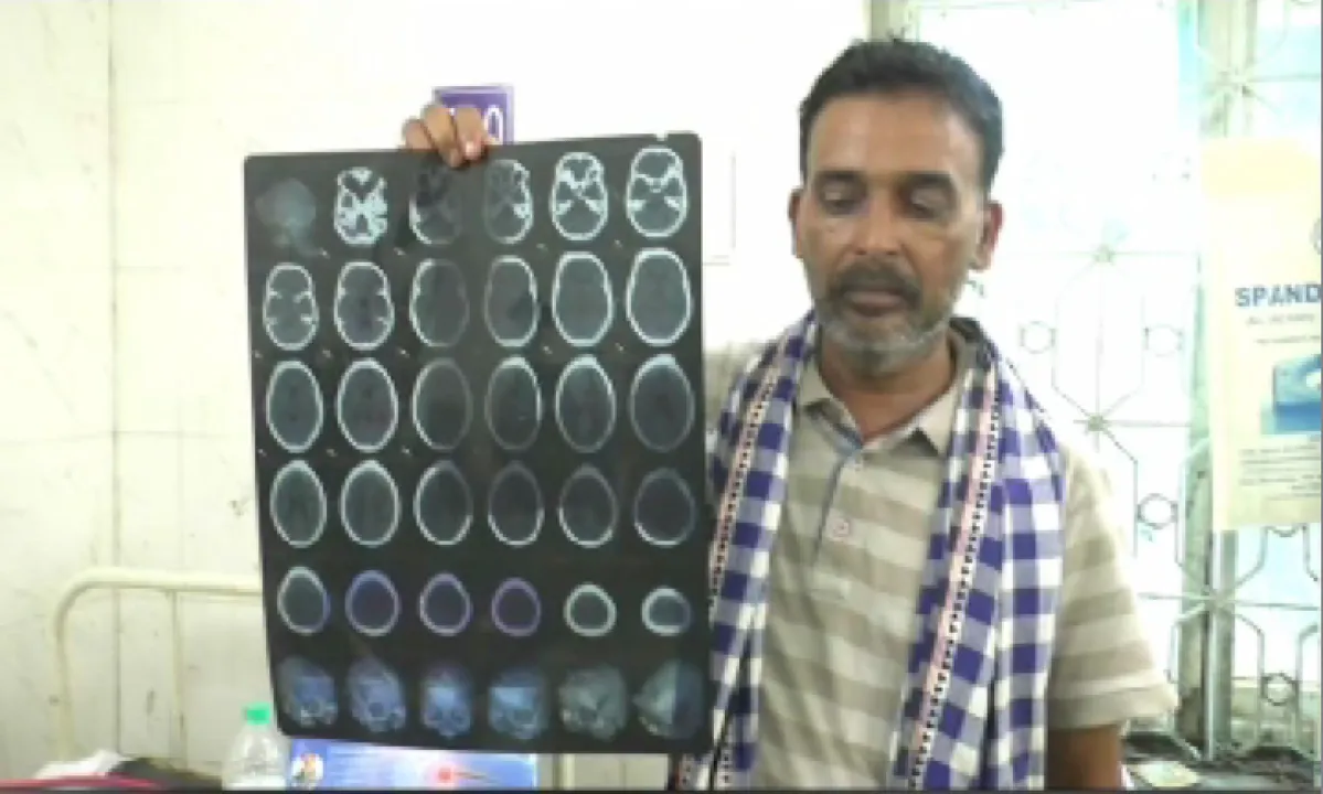  ଯୁବତୀଙ୍କ ମୁଣ୍ଡରୁ ପୁଣି ବାହାରିଲା ୭ଟି ଛୁ୍ଞ୍ଚି ,ପୂର୍ବରୁ ବାହାରି ସାରିଛି  ୭୦ରୁ ଅଧିକ  ଛୁଞ୍ଚି । ମୁଣ୍ଡରେ ଅଧିକ ଛୁଞ୍ଚି ଥିବା ନେଇ ସ୍କାନ ରିପୋର୍ଟରେ ଜଣାପଡ଼ିବା ପରେ ପୁଣି ଅପରେସନ