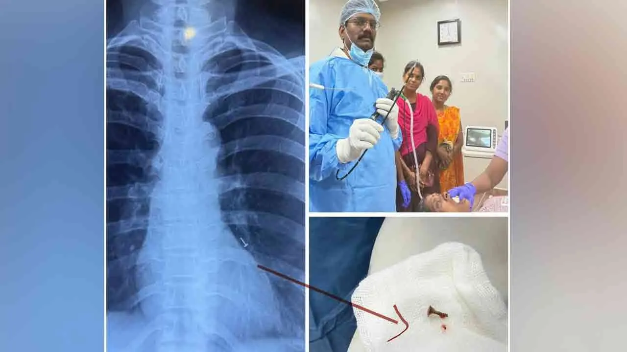  doctor removed through treatment A gold nose ring was lodged in the lungs 