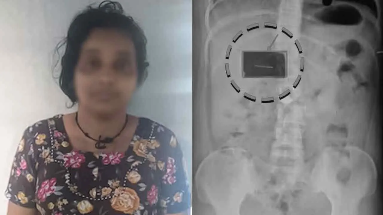  காணாமல் போன தங்க நகை; எக்ஸ்ரேவில் வெளியான அதிர்ச்சி தகவல்!