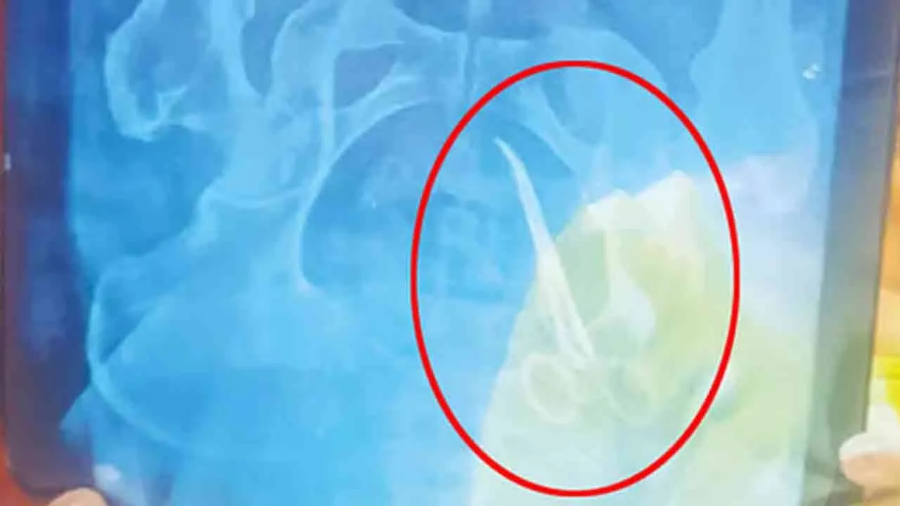  kerala Government doctors performed surgery on a woman's stomach with scissors 