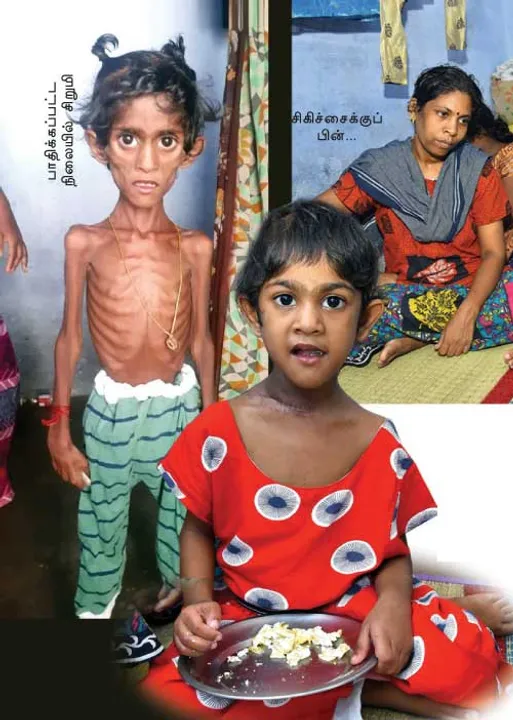  முதல்வர் -அமைச்சர் உதவியால் மறுஜென்மம் எடுத்த மகள்! -நன்றிப் பெருக்கில் பெற்றோர்!