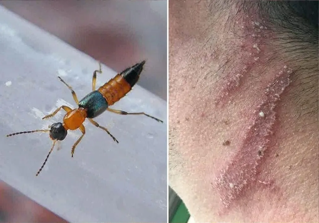 100 Students Infected with Nairobi Flies in Sikkim