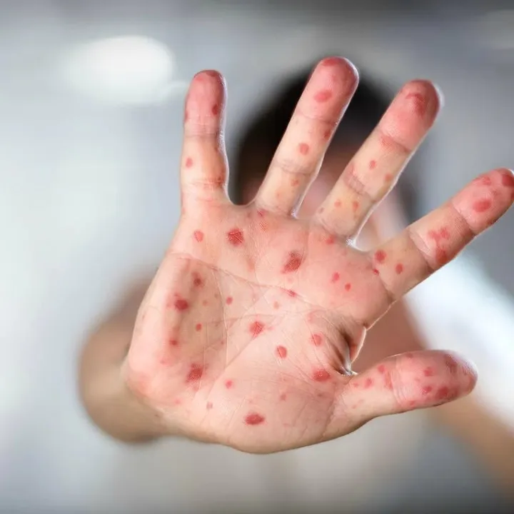 Coxsackievirus A16 Spreads Rapidly Among Children in Assam