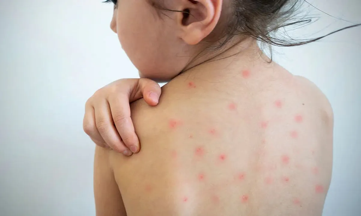 Measles Outbreak Claims 9 Lives In Mumbai