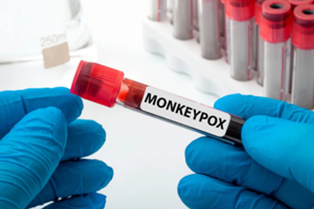  Second Mpox case detected in Kerala