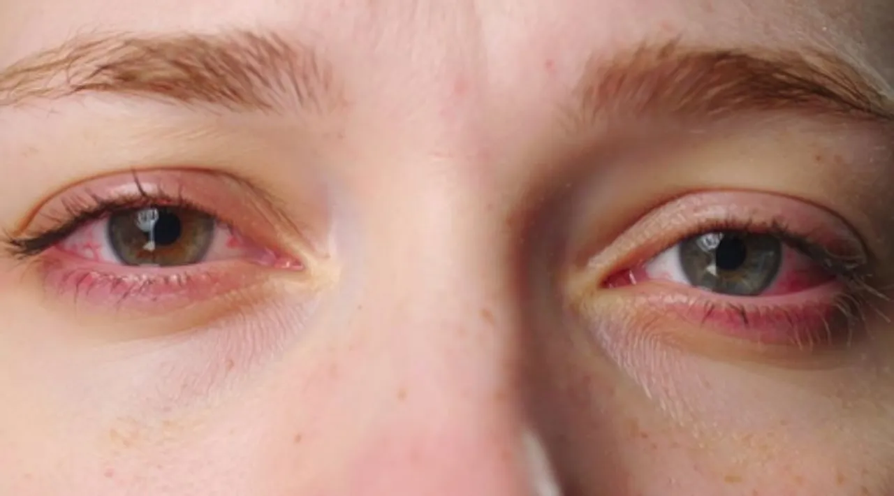  Just 1 hour of smartphone reels can trigger eye fatigue, finds study