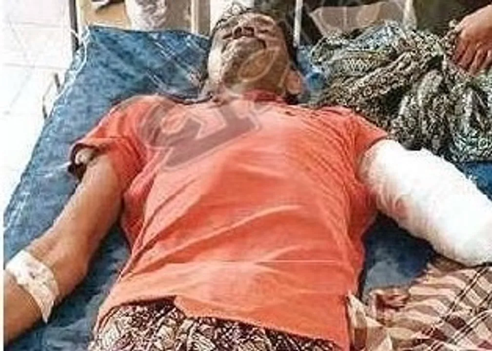  The injured victim in crocodile attack 