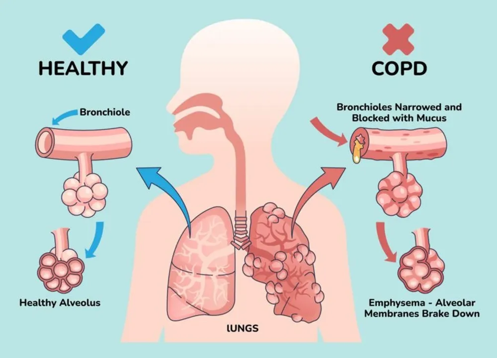  Breathe Easy: Know COPD Before It Stops You