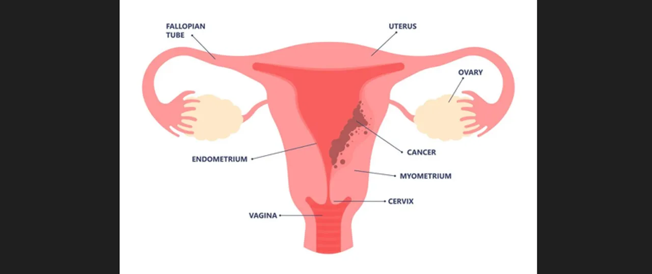  Why gynaecological cancers are rising among young Indian women