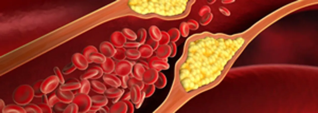  How high cholesterol, microplastics are contributing to rising heart diseases