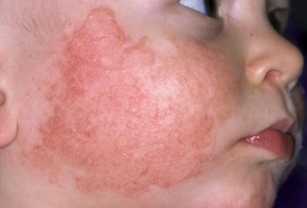  Hard water linked to risk of itchy red rash in infants