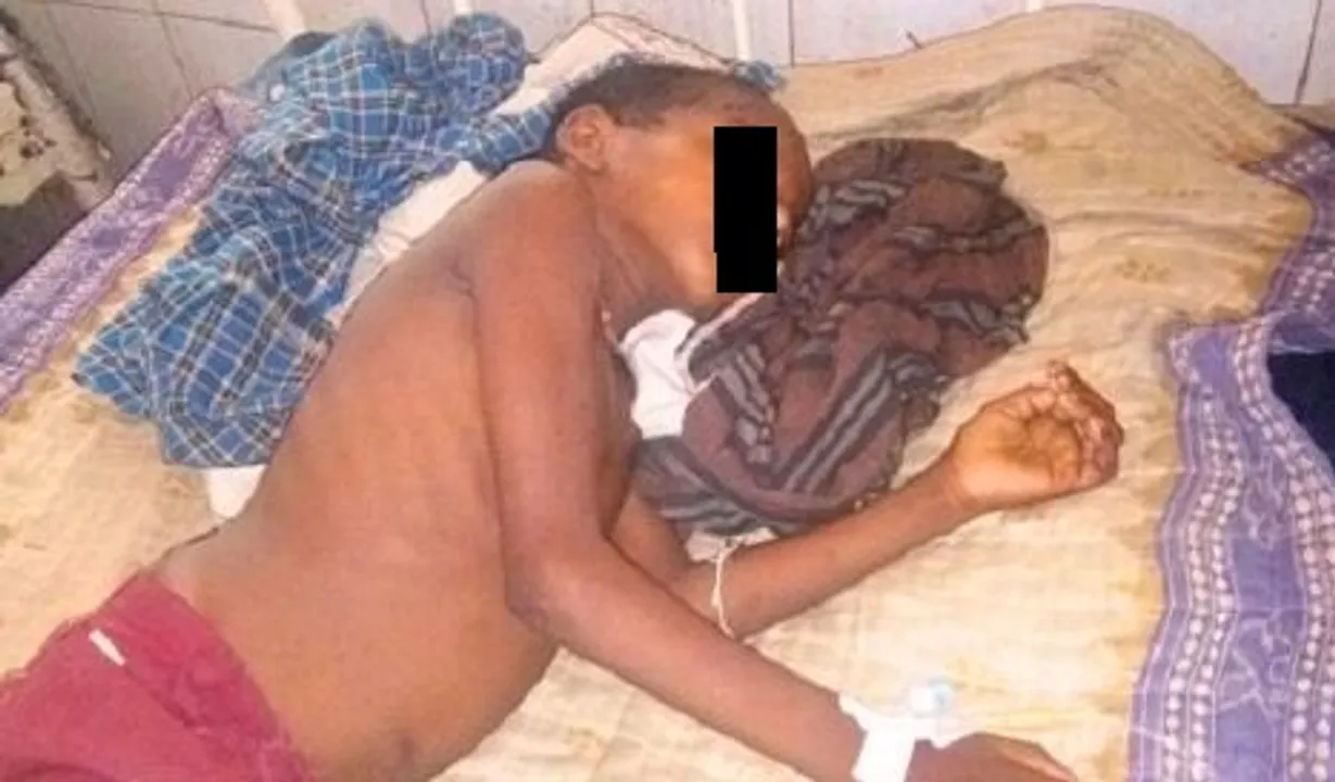  Eight-year-old branded in Odisha’s Keonjhar