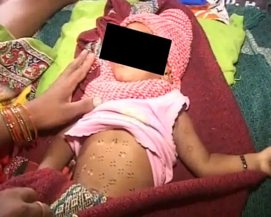  7-month-old infant branded in Odisha