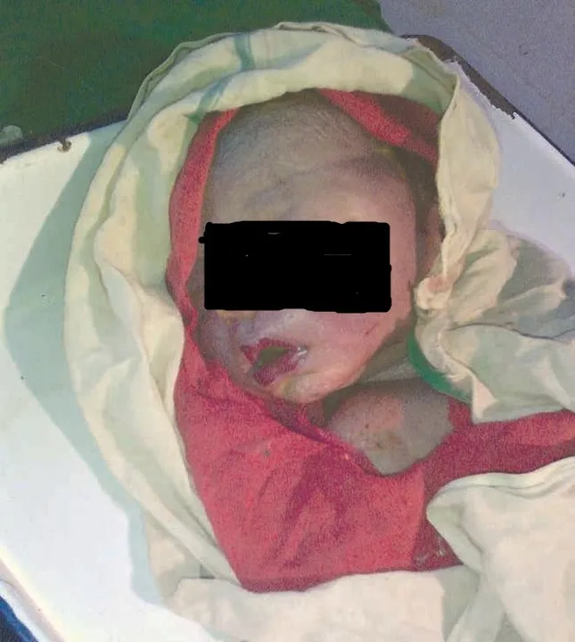  Newborn baby dies due to medical negligence in Odisha