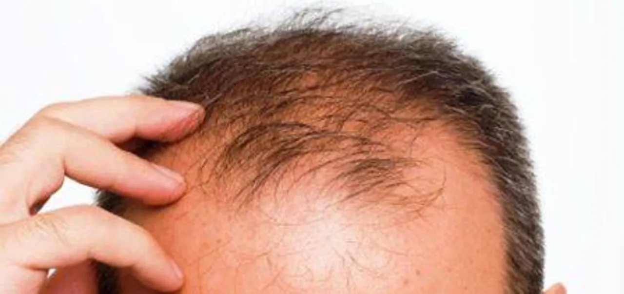  Here comes a device to regrow hair on bald head