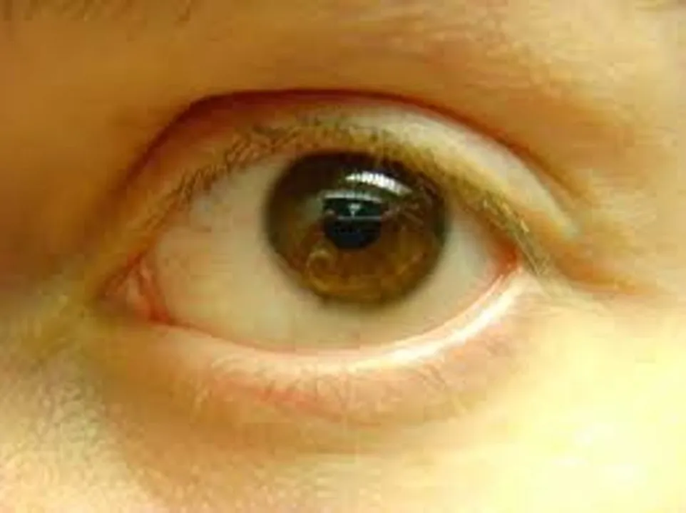  Jaundice outbreak in Odisha’s Cuttack gets alarming: 33 new cases detected