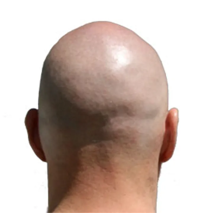  Know why you turn bald