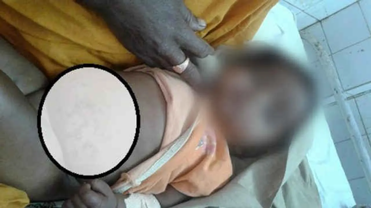  Barbaric practice: Two babies branded with hot iron rod in Odisha